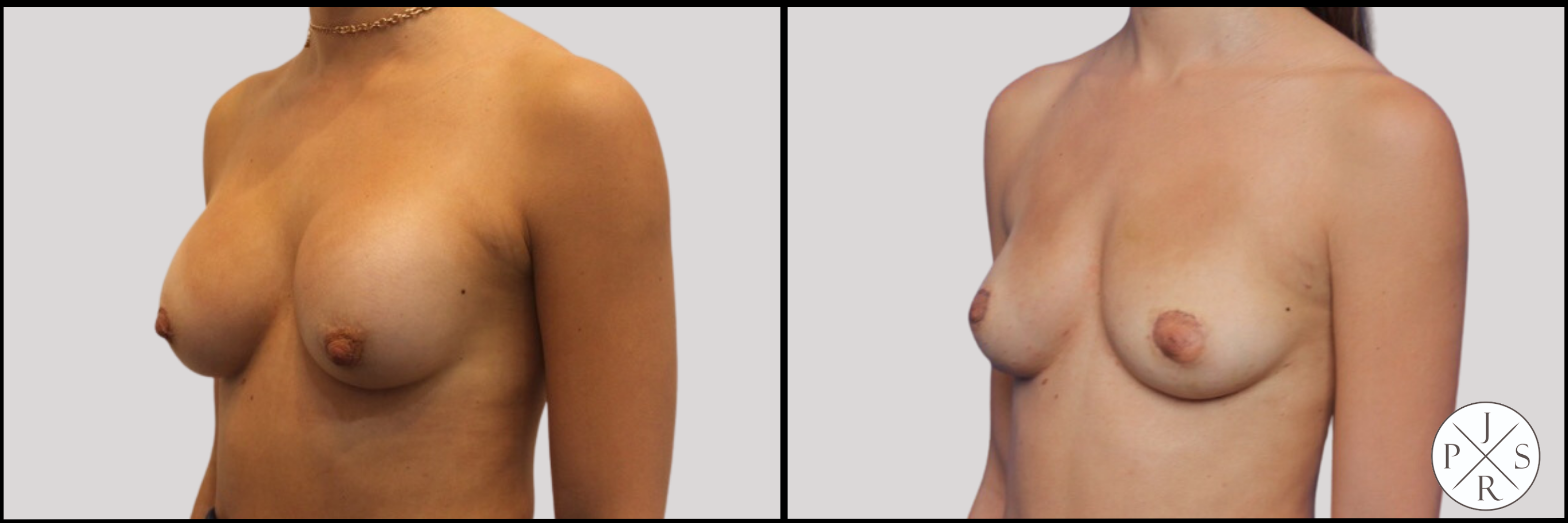 Breast Implant Removal Before & After Image